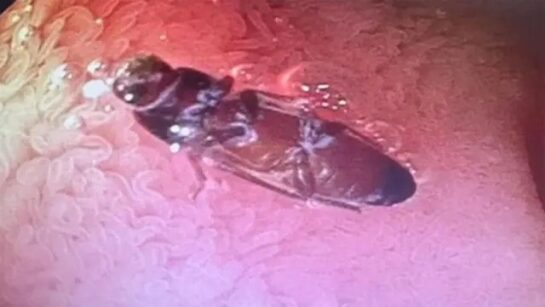 Un Joven De 23 Anos Descubre Una Cucaracha Viva En Su Intestino