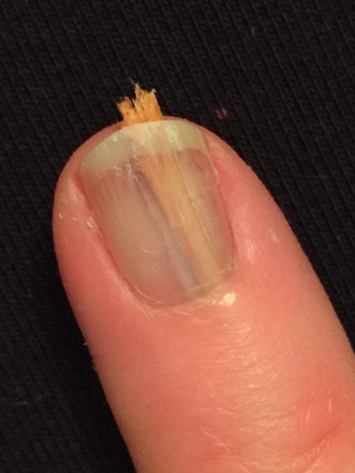 Esta imagen trasmite dolor y ñañaras solo con verla... 9 esta imagen trasmite dolor y nanaras solo con verla