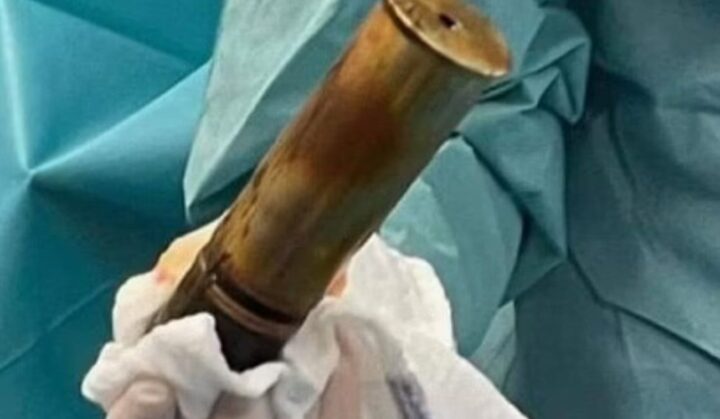 llego con una bomba en el recto en un hospital de francia 20221221 1477676